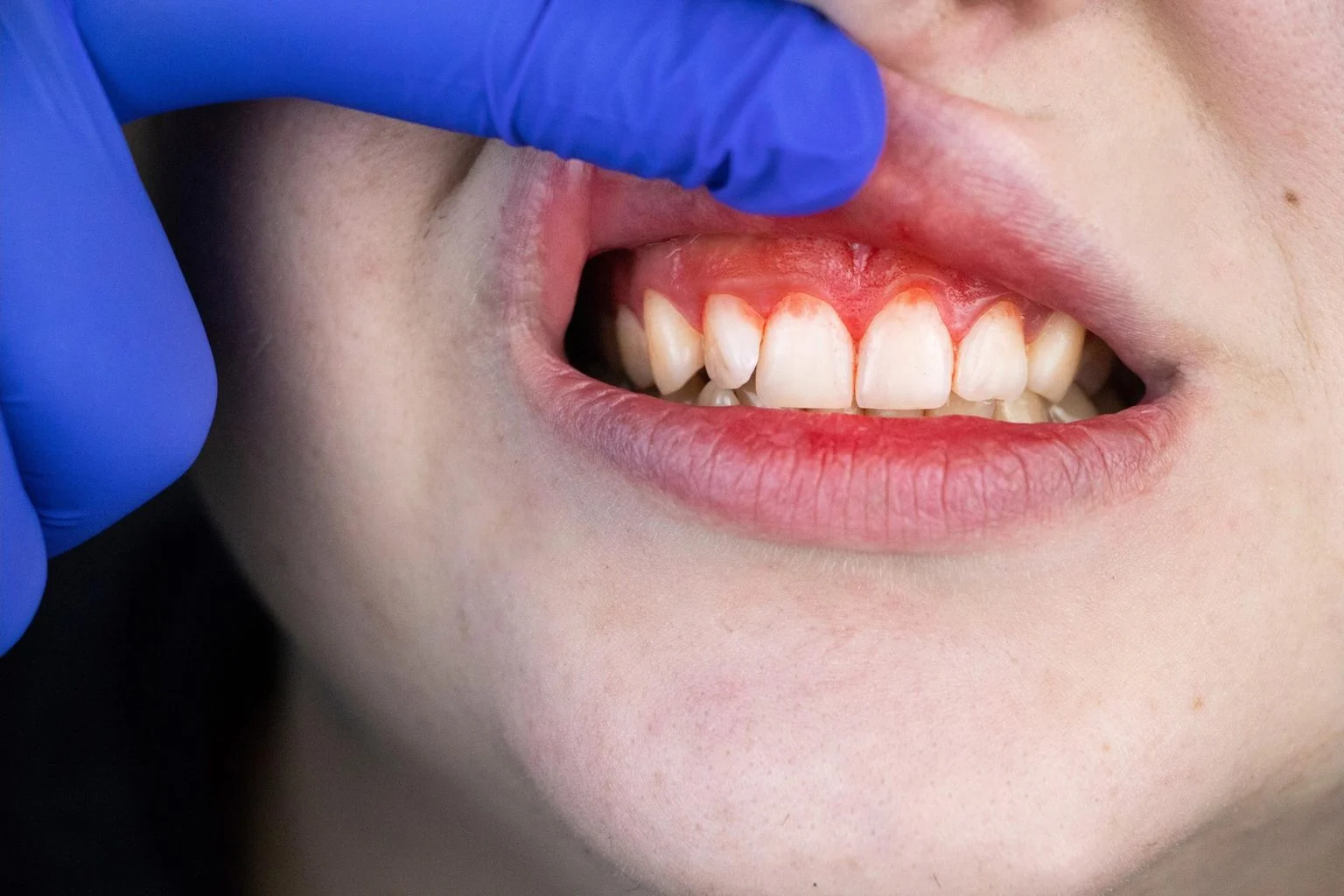 before Periodontics
