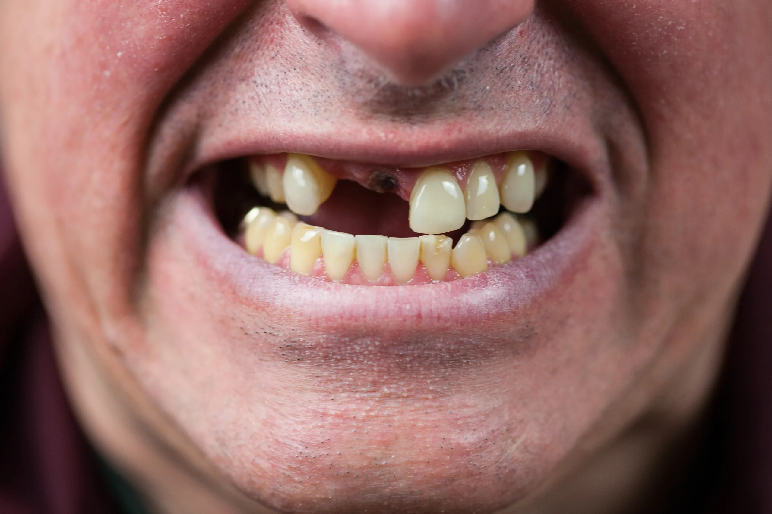 Before dental implants