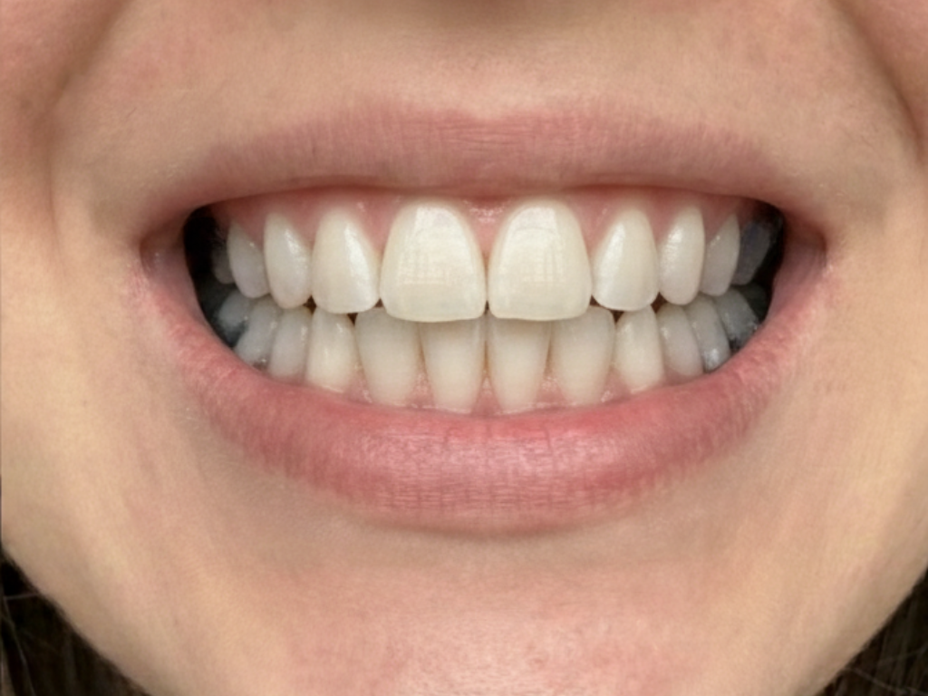 teeth after removing braces